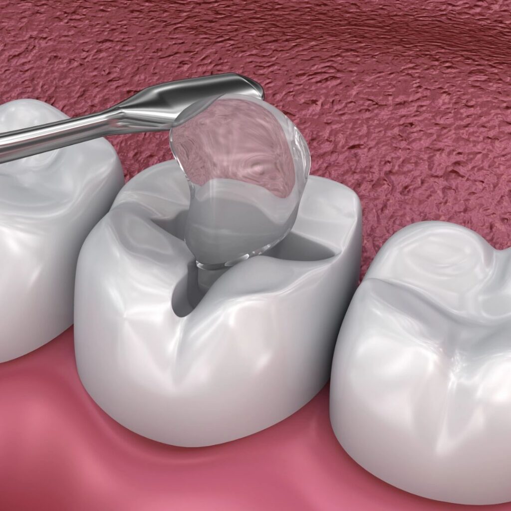 dental crown orange california