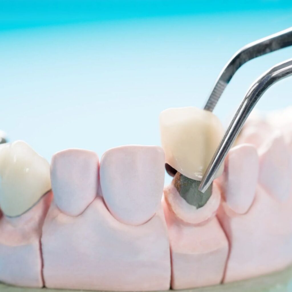 dental crowns orange