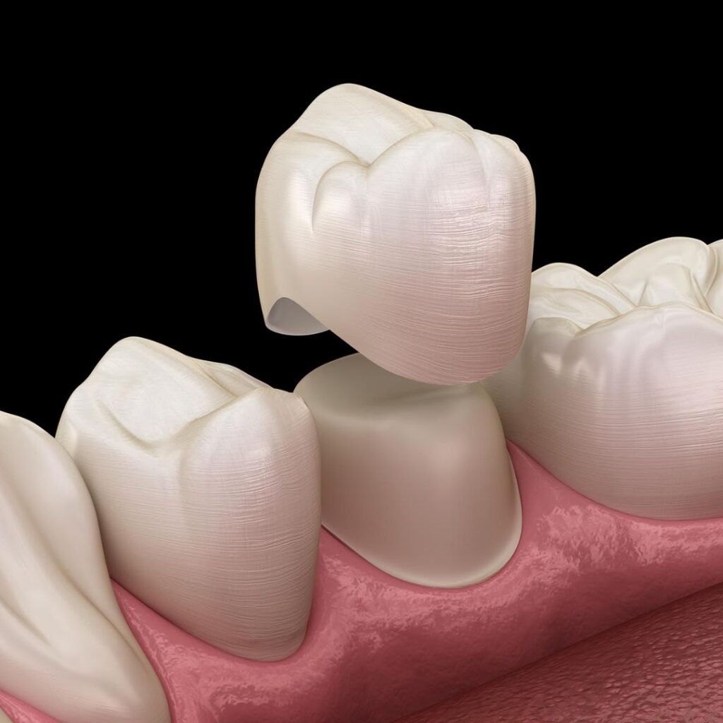 orange dental crowns