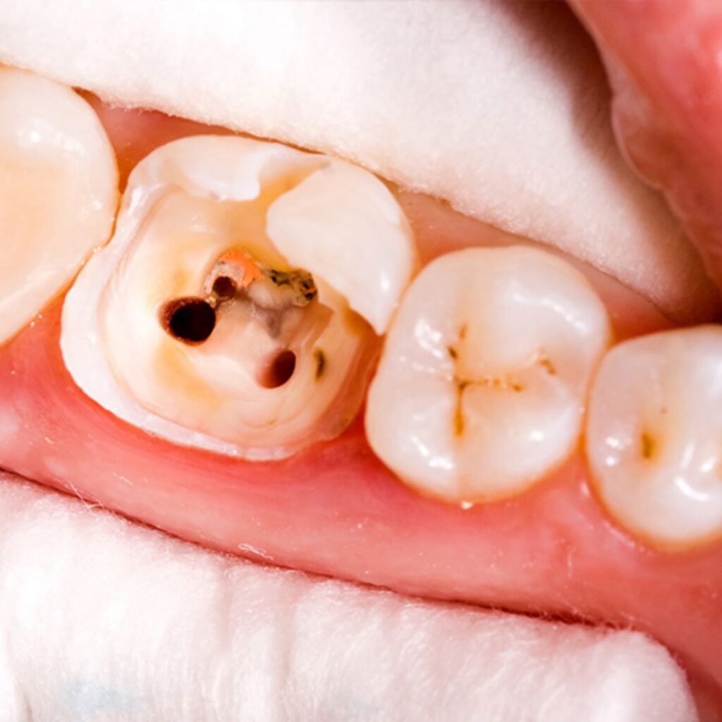 orange root canal