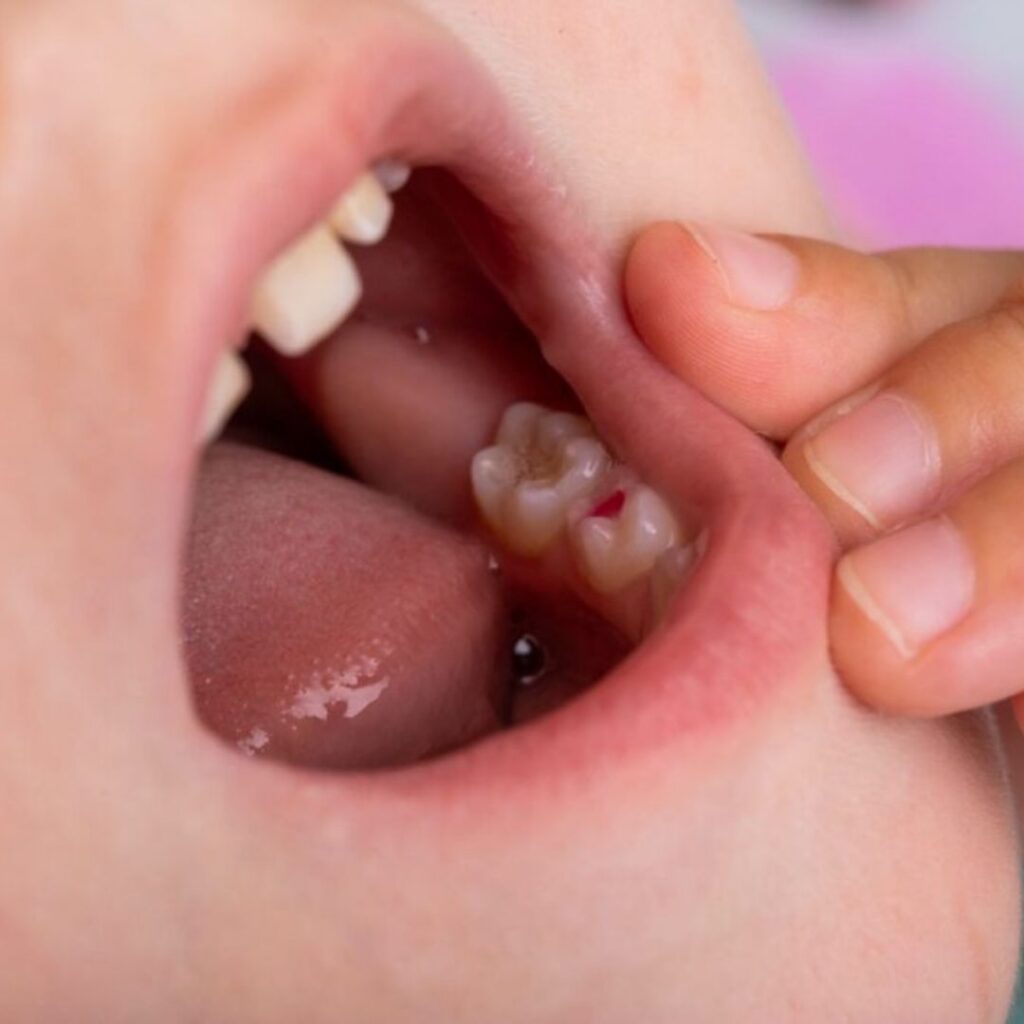 orange root canals
