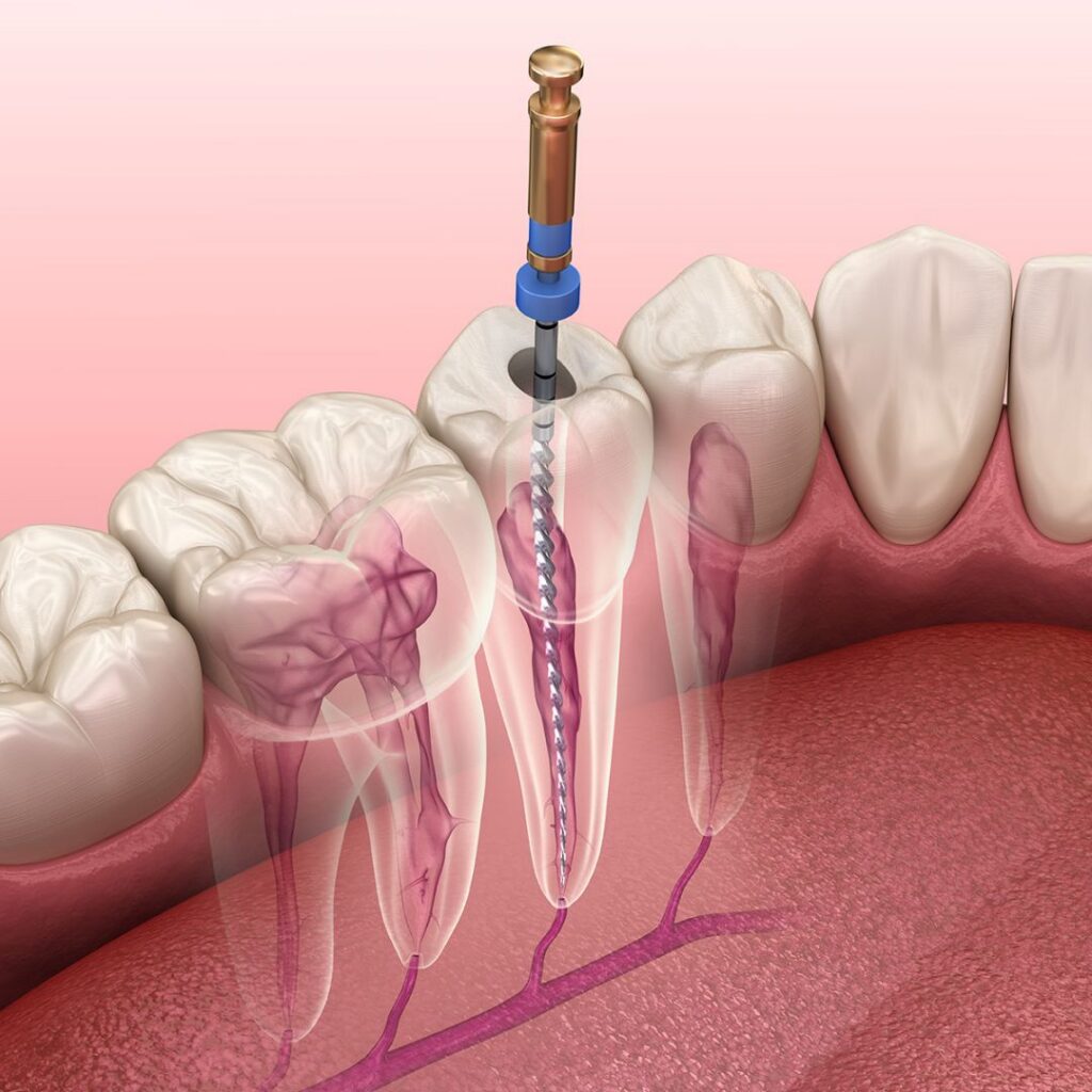 root canal orange