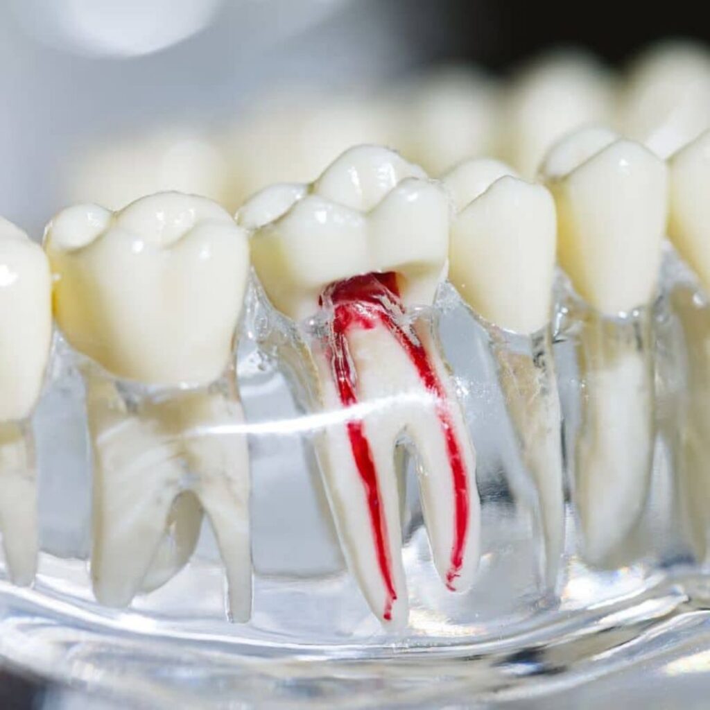 root canal orange ca