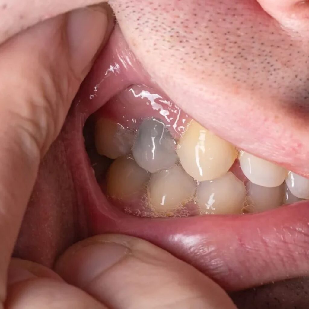 root canal therapy orange